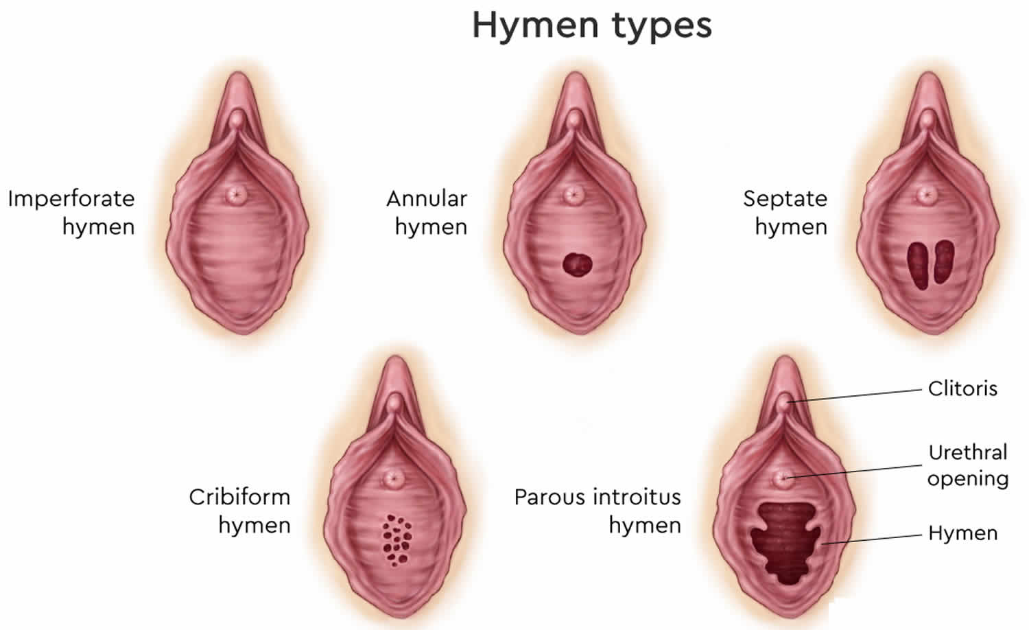 hymen types